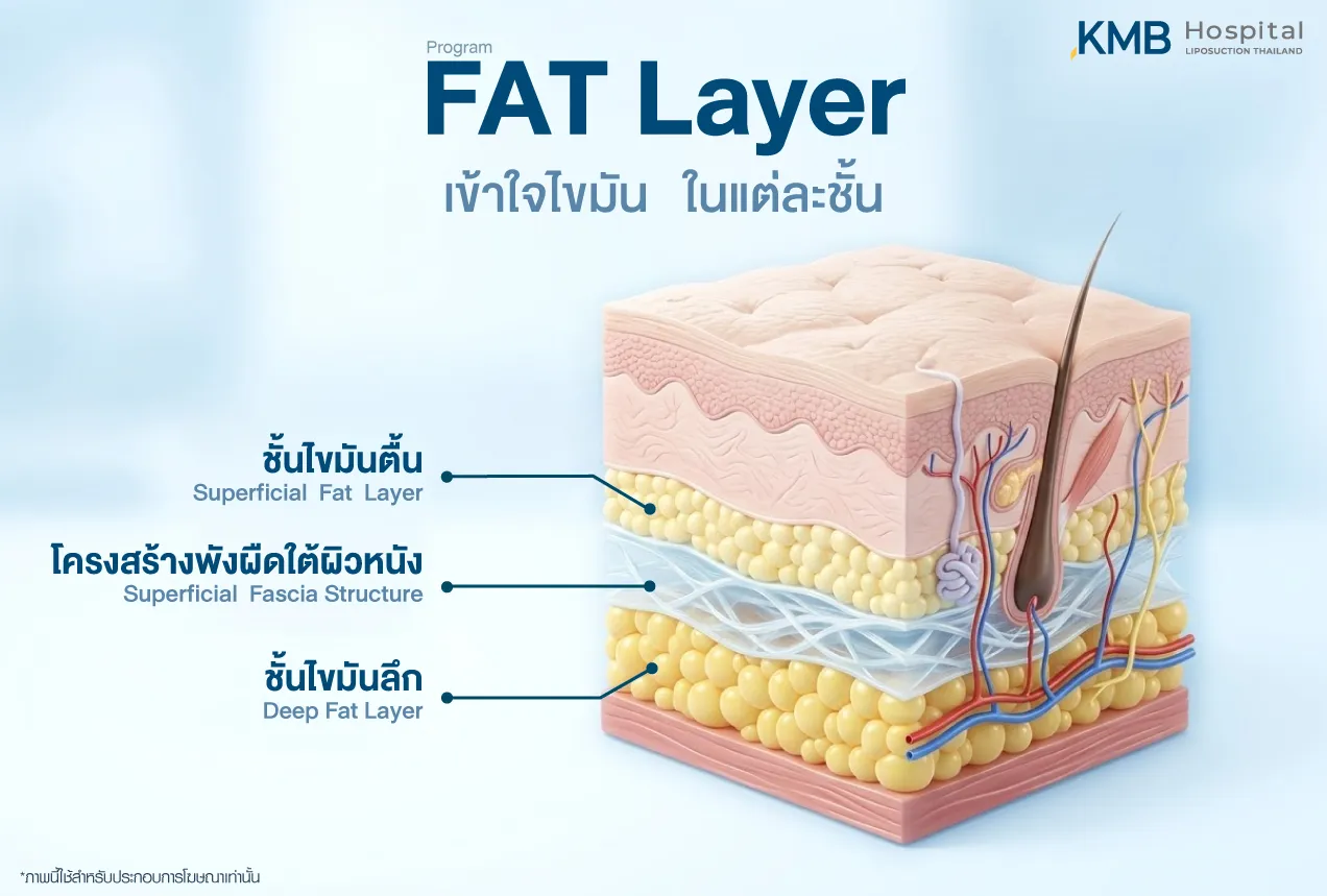 อินโฟกราฟิก KMB Hospital แสดงโครงสร้างชั้นไขมัน ได้แก่ ชั้นไขมันตื้น โครงสร้างพังผืดใต้ผิวหนัง และชั้นไขมันลึก เพื่อช่วยให้เข้าใจความแตกต่างของแต่ละชั้นก่อนวางแผนโปรแกรมดูดไขมัน