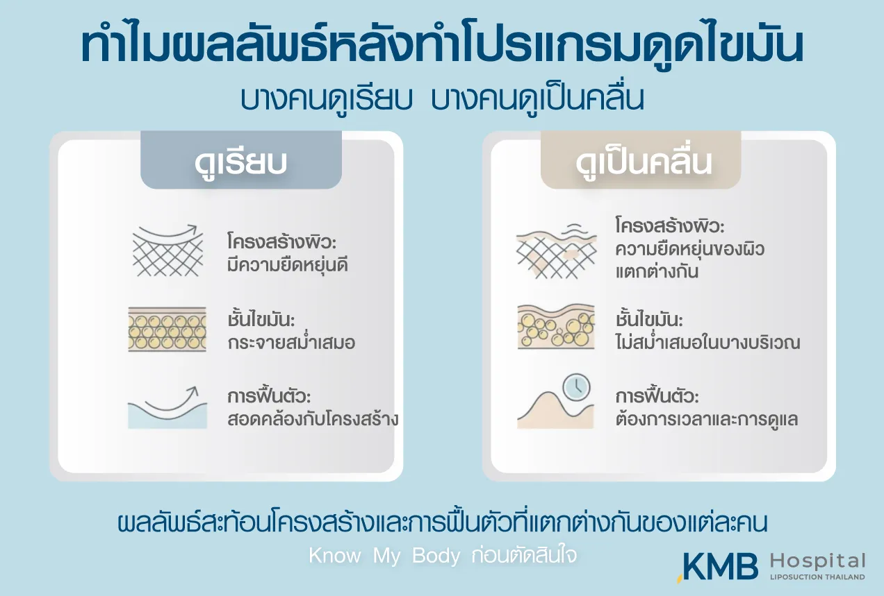 ภาพอินโฟกราฟิก KMB Hospital อธิบายว่าผลลัพธ์หลังโปรแกรมดูดไขมันอาจดูเรียบหรือเป็นคลื่นแตกต่างกันตามความยืดหยุ่นของผิว การกระจายของชั้นไขมัน และการฟื้นตัวของแต่ละบุคคล